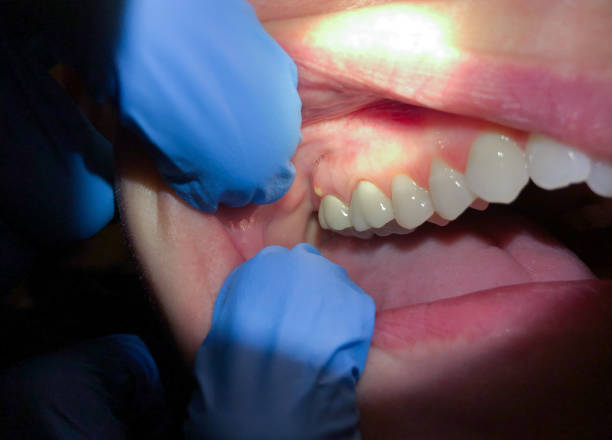 Best Emergency Denture Repair in Faxon, PA